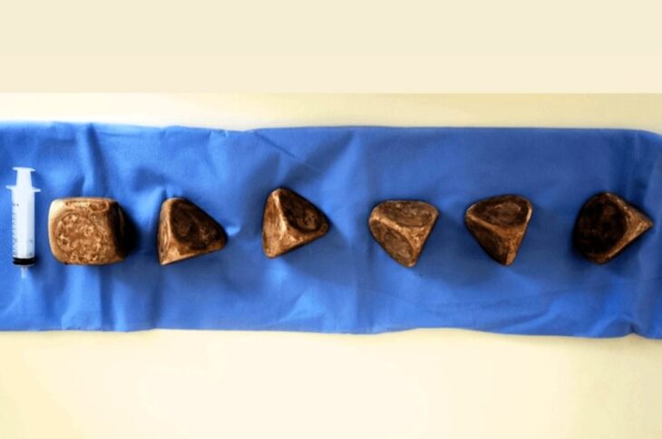 Новини світу - У сечовому міхурі чоловіка знайшли 2 кг каменів