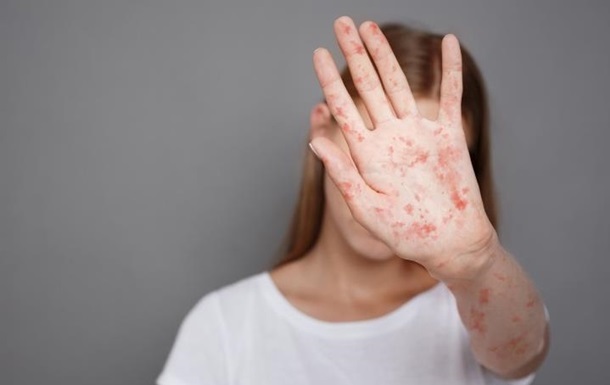 Новини України - В Україні стрімко зростає захворюваність на кір