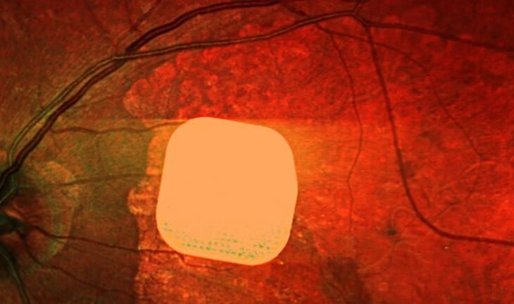 Технології - Британські лікарі частково повернули зір пацієнтам за допомогою мікрочипа